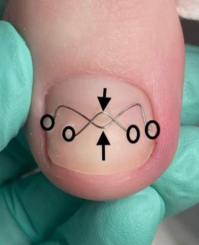 Brace M (Nagelspangen)